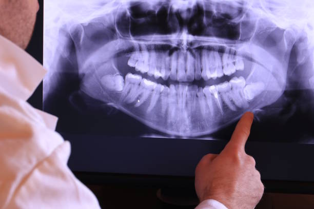 Best Emergency Tooth Extraction in Ilco, WA