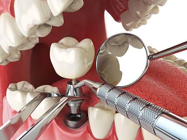 Best Emergency Broken Tooth Repair in Ilco, WA